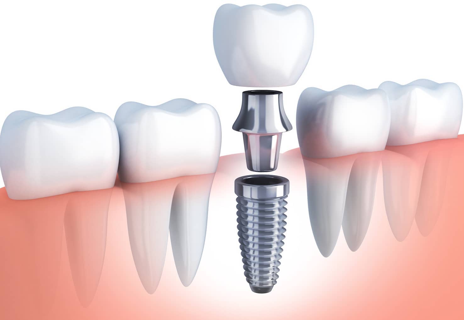 Details zum Implantat