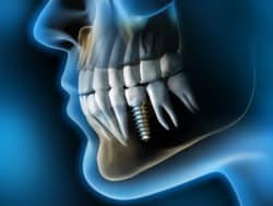 Röntgenbild von Zahnimplantate im Gebiss in Wien